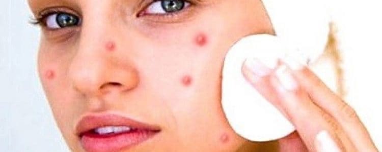 How To Get Pimple Free Skin In One Day Naturally How To Get Pimple Free Skin In One Day Naturally